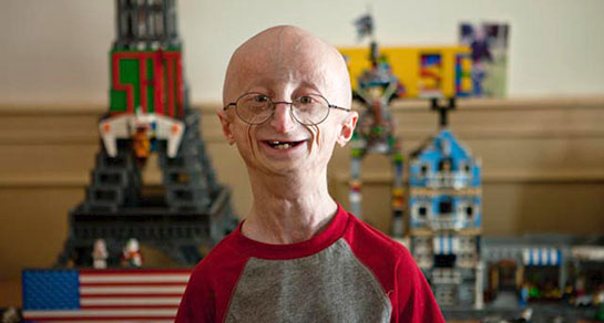 Progeria Özellikleri ve Faydaları Nelerdir?